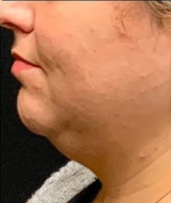 Before Image: Kybella double chin treatment - left-side