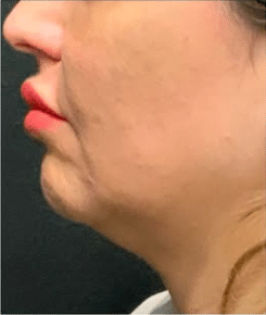 After Image: Kybella double chin treatment - left-side