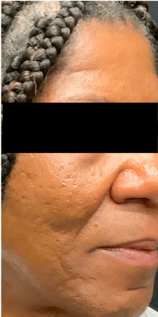 After Image: Photofacial and Chemical Peel Treatments - right-side