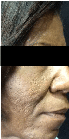 Before Image: Photofacial and Chemical Peel Treatments - right-side