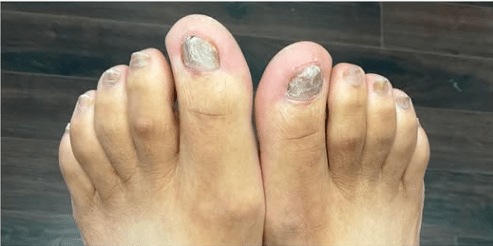 After Image: Toe Nail Fungus Treatment - other