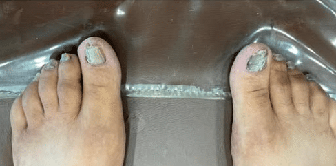 Before Image: Toe Nail Fungus Treatment - other