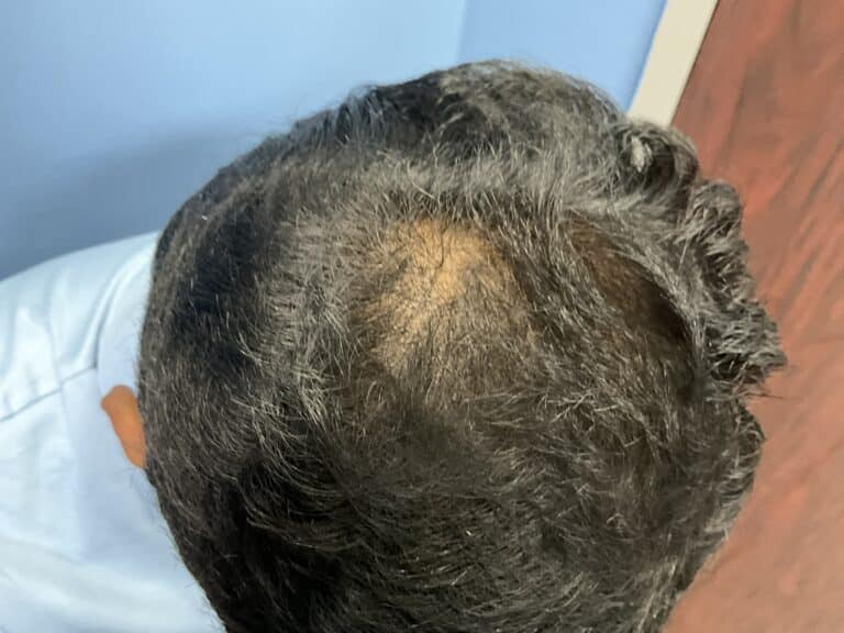 After Image: Hair Restoration Treatment - front