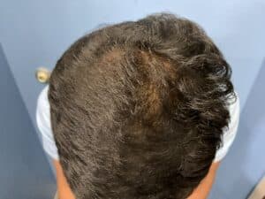 After Image: Hair Restoration Treatment