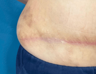 After Image: Tummy tuck scar pixel treatment - front