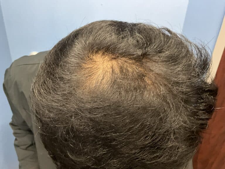 Before Image: Hair Restoration Treatment - front