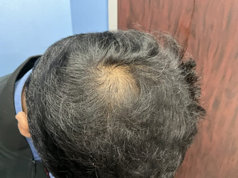 Before Image: Hair Restoration Treatment - front
