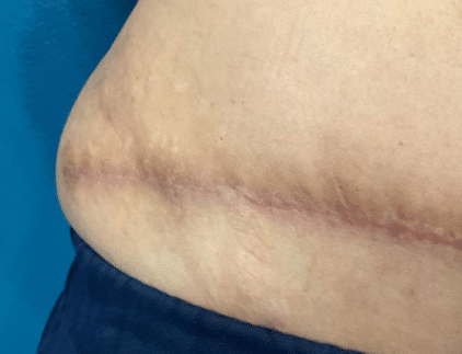 Before Image: Tummy tuck scar pixel treatment - front