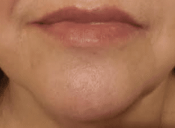 After Image: Lip Filler – Juvederm Ultra Plus - front