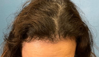 After Image: Thinning Hair treatment microneedling with prp - front