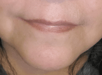 Before Image: Lip Filler – Juvederm Ultra Plus - front