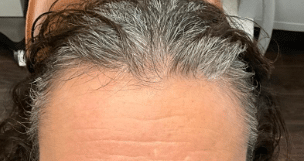 Before Image: Thinning Hair treatment microneedling with prp - front