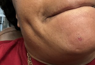 After Image: Skin Tag Treatment - front