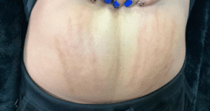 After Image: Pixel and Luma Forte Treatment for stomach stretch marks