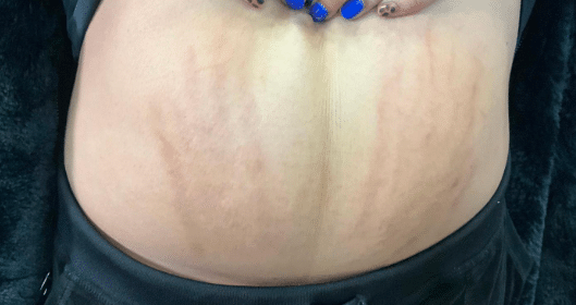 After Image: Pixel and Luma Forte Treatment for stomach stretch marks - front