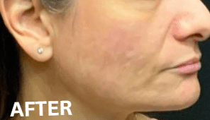After Image: Blue Light Therapy and Chemical Peel Treatment - front