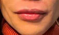 After Image: Juvederm Ultra Plus Lip Filler - front