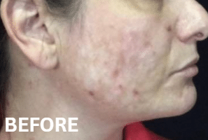 Before Image: Blue Light Therapy and Chemical Peel Treatment - front