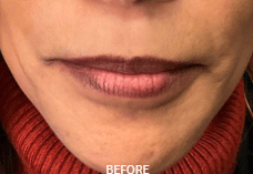 Before Image: Juvederm Ultra Plus Lip Filler - front