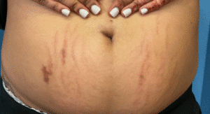 Before Image: Pixel and Luma Forte Treatment for stomach stretch marks