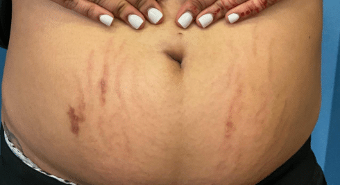 Before Image: Pixel and Luma Forte Treatment for stomach stretch marks - front