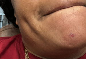 After Image: Skin Tag Removal Treatment