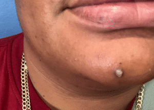 Before Image: Skin Tag Removal Treatment